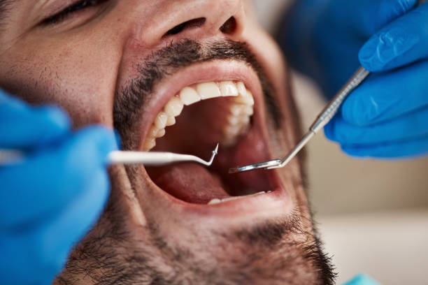 Best Emergency Dentist for Lost Fillings or Crowns in Rural Hall, NC